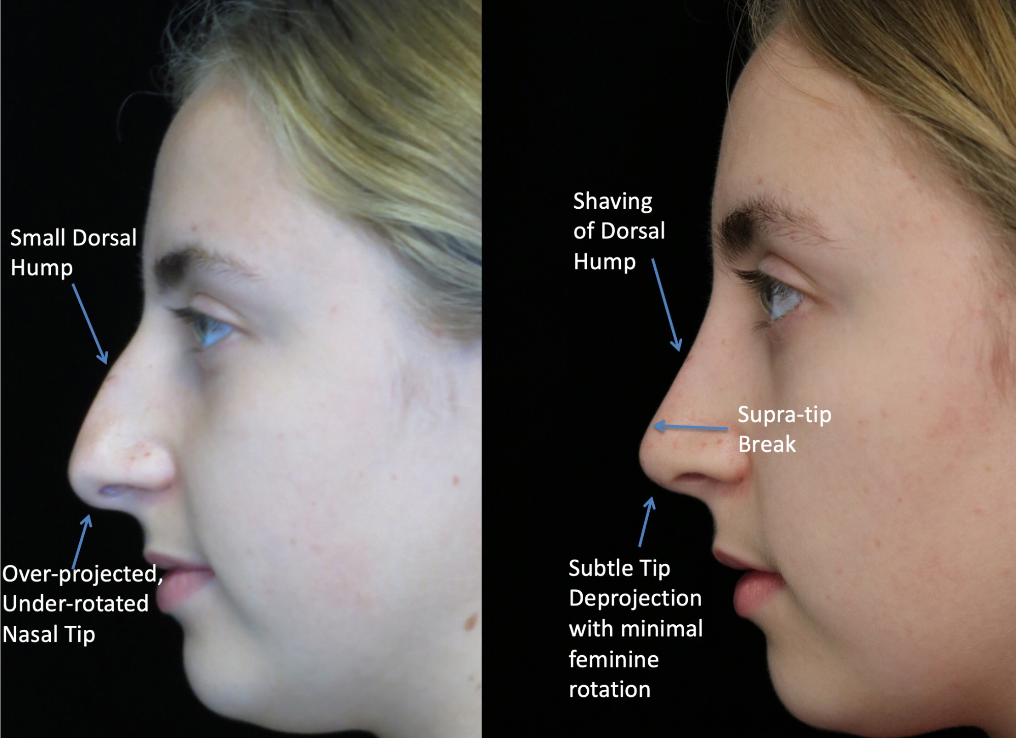 What Is Closed Rhinoplasty? Closed rhinoplasty for bulbous nose tip